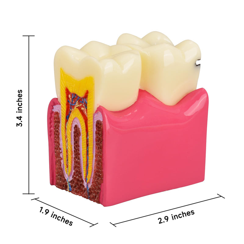 [Australia - AusPower] - Dental Tooth Decay Model 6 Times Dental Caries Teeth Model Caries Bilateral Comparison Pathology Model Teeth for Dental Education Supplies, Tooth Pathology Display 