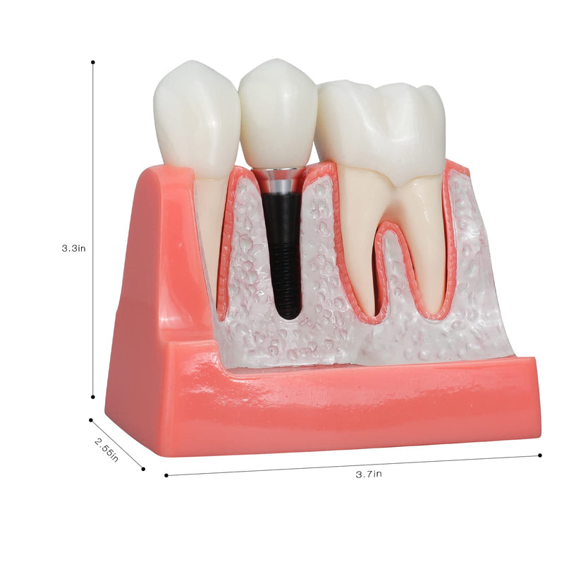 [Australia - AusPower] - ANNWAN Dental Implant Model 4 Times Removable Analysis Crown Bridge Demonstration Teeth Model for Class Education and Studying Teeth Model 
