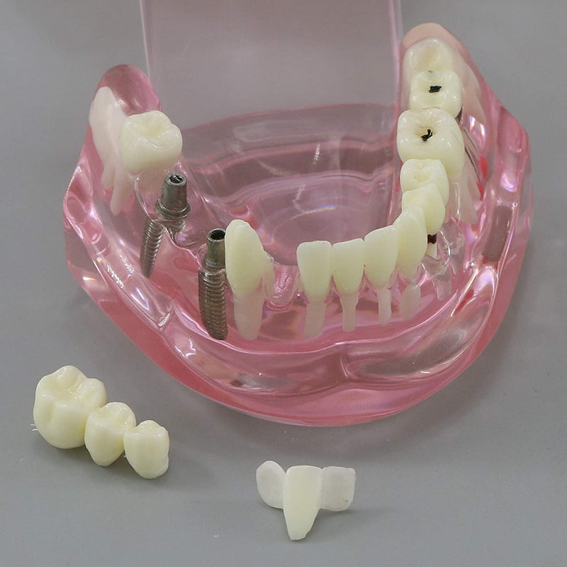 Dental Typodont Model Implant Restoration Tooth Model Disease Pathology Analysis Teeth Bridge Crown Teach Study Tooth Education