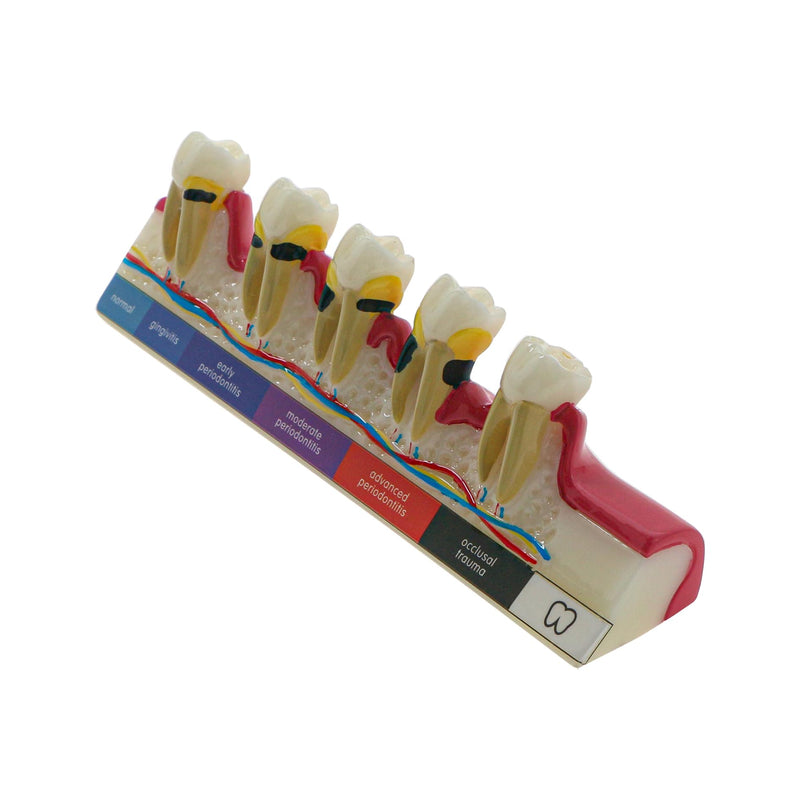 [Australia - AusPower] - Dental Teeth Model 6-Stage Periodontal Disease Demonstration Model for Dental Education 