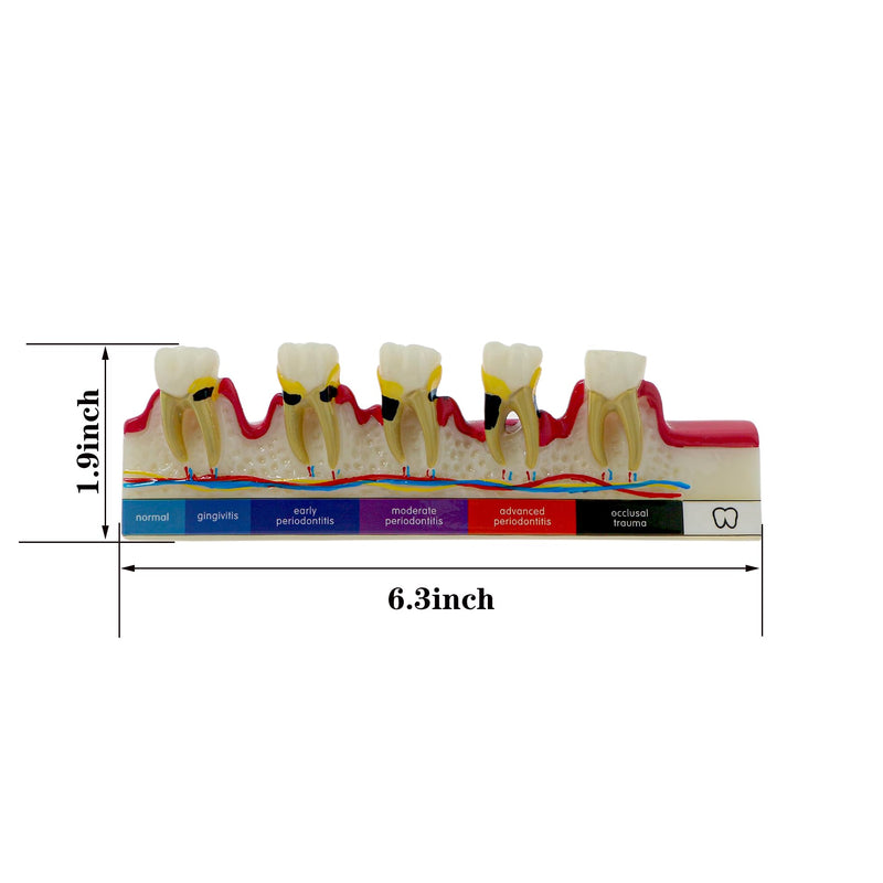 [Australia - AusPower] - Dental Teeth Model 6-Stage Periodontal Disease Demonstration Model for Dental Education 