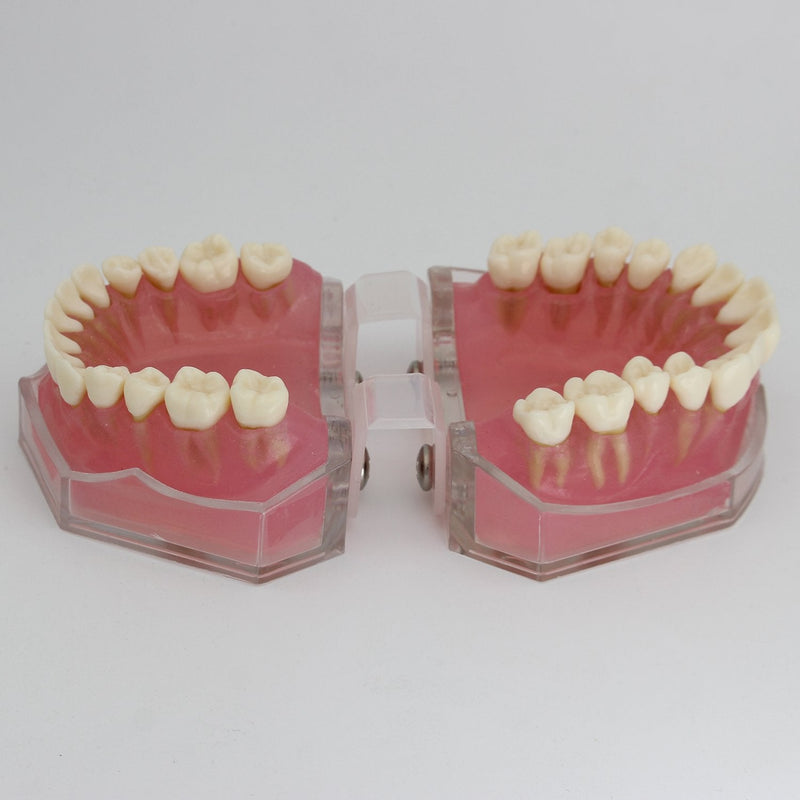 [Australia - AusPower] - Dental Implant Teeth Model Study Teach Standard Model with Removable Teeth 