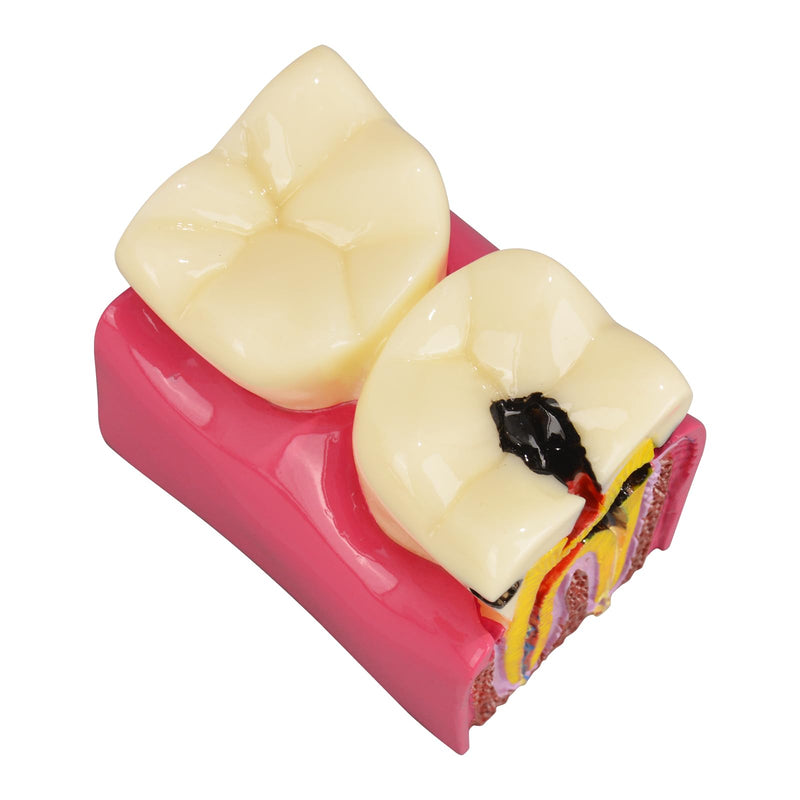[Australia - AusPower] - Dental Tooth Decay Model 6 Times Dental Caries Teeth Model Caries Bilateral Comparison Pathology Model Teeth for Dental Education Supplies, Tooth Pathology Display 