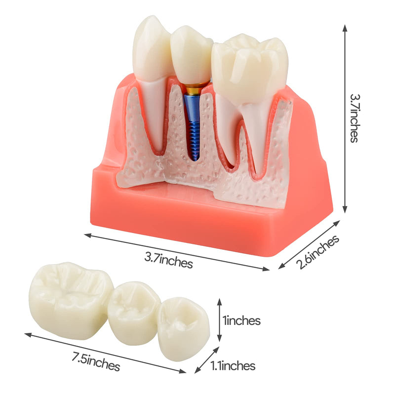 [Australia - AusPower] - Dental Implant Model for Patient Education, 4 Times Dental Implant, Crown and Bridge Model for Presentation-Pink 
