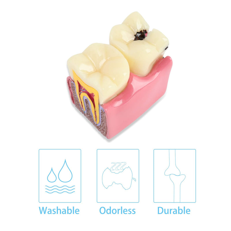 Dental Caries Tooth Model 6 Times Decay Teeth Comparative Study Model, Caries Bilateral Comparison Pathology Teeth Model Teaching Learning Tools for Dentist, Patient Education and Explanation