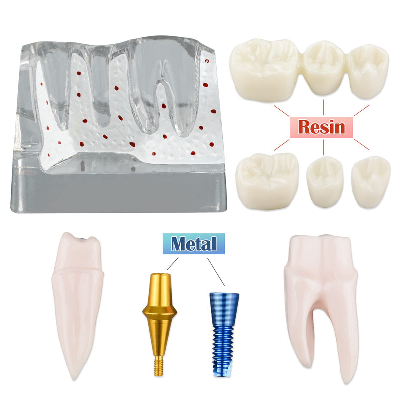 [Australia - AusPower] - Dental Implant Model for Patient Education, 4 Times Dental Implant, Crown and Bridge Model for Presentation-Transparent 