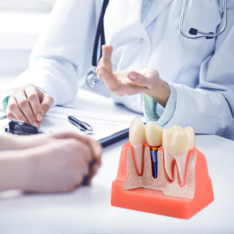 [Australia - AusPower] - Dental Implant Model for Patient Education, 4 Times Dental Implant, Crown and Bridge Model for Presentation-Pink 