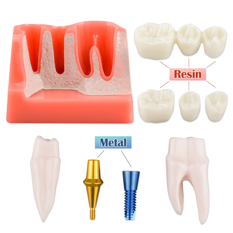 [Australia - AusPower] - Dental Implant Model for Patient Education, 4 Times Dental Implant, Crown and Bridge Model for Presentation-Pink 