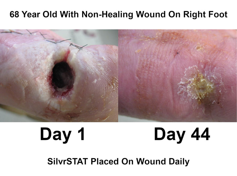 [Australia - AusPower] - First Aid Kit Gel | 32 PPM Silver Healing Wound Dressing Solution | SilverSol Ag₄O₄ Particles | 3 oz 3 Ounce 