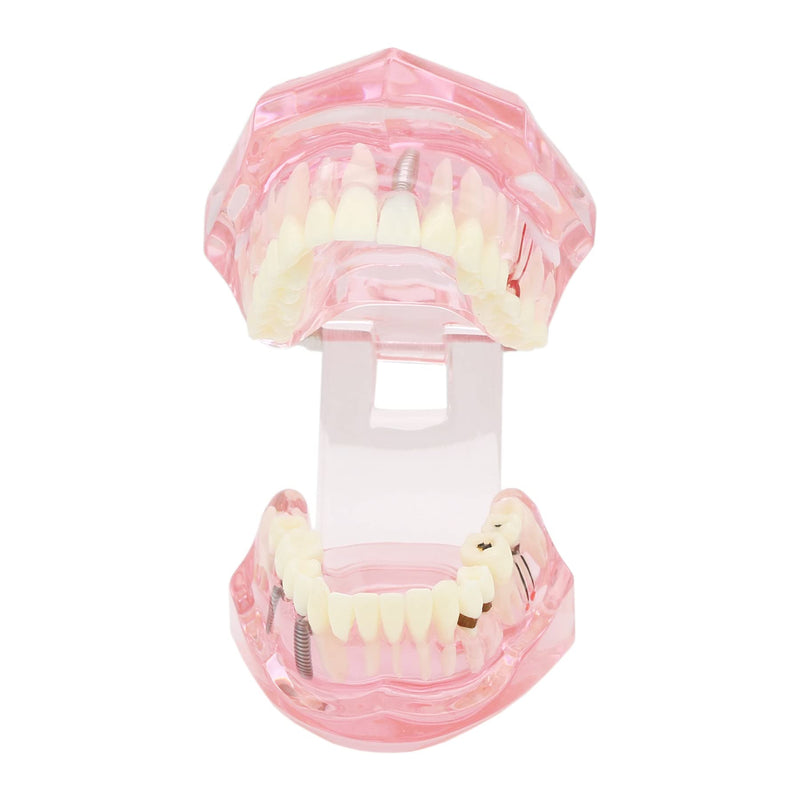 [Australia - AusPower] - Teeth Model Teeth Typodonts Dental Implant Study Analysis Demonstration Teeth Model #2001 with Restoration Pink 