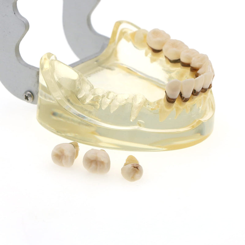 [Australia - AusPower] - Dental Teeth Typodonts Model for Parodontopathy Periodontal Disease, Removable Gingivae Pathology Teeth Model Used in Teaching,Explain,Studying for Adult(Transparent) 