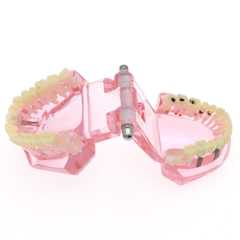 [Australia - AusPower] - Teeth Model Teeth Typodonts Dental Implant Study Analysis Demonstration Teeth Model #2001 with Restoration Pink 