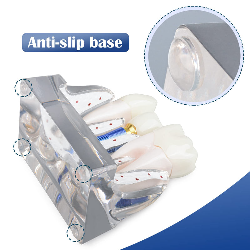 [Australia - AusPower] - Dental Implant Model for Patient Education, 4 Times Dental Implant, Crown and Bridge Model for Presentation-Transparent 