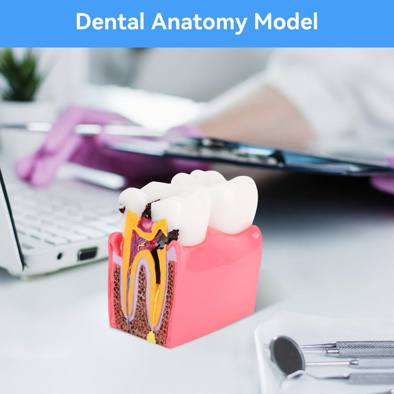 Dental Anatomy Model, Caries Comparison Study Models Dentist Dental Anatomy Training Dental Caries Development Model