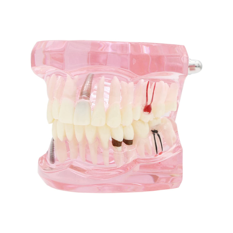 [Australia - AusPower] - Teeth Model Teeth Typodonts Dental Implant Study Analysis Demonstration Teeth Model #2001 with Restoration Pink 