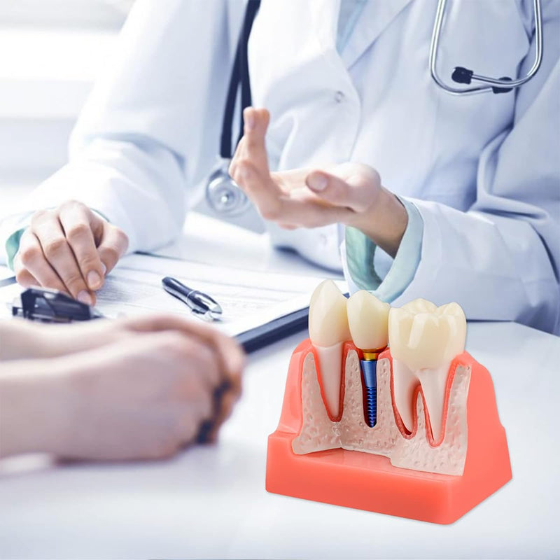 Sarini Oral Dental Model, Dental Implant Model with Removable Crown and Bridge, Suitable for Classroom Demonstrations and Dental Student Training