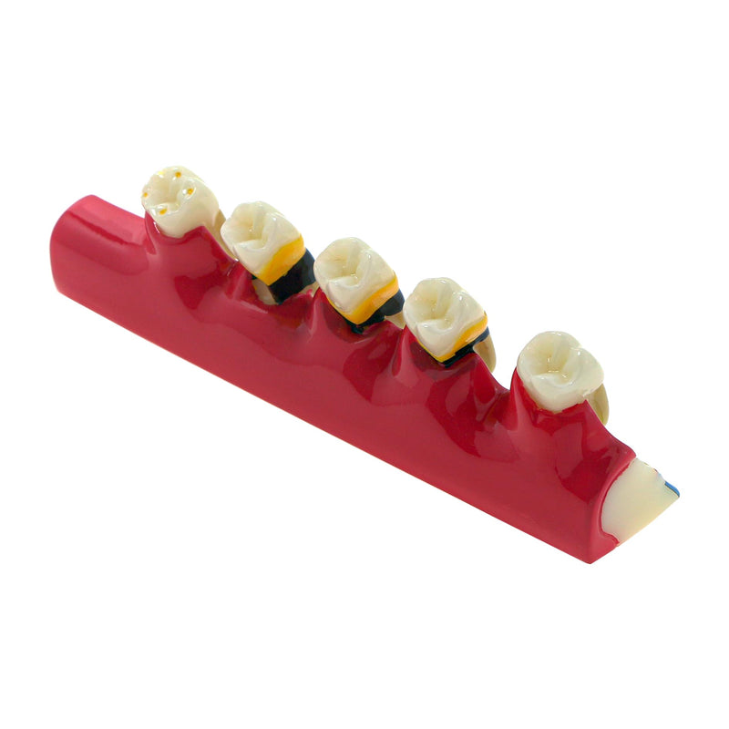 [Australia - AusPower] - Dental Teeth Model 6-Stage Periodontal Disease Demonstration Model for Dental Education 