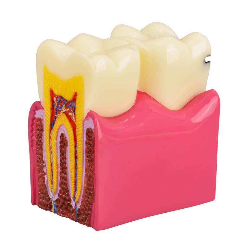 [Australia - AusPower] - Dental Tooth Decay Model 6 Times Dental Caries Teeth Model Caries Bilateral Comparison Pathology Model Teeth for Dental Education Supplies, Tooth Pathology Display 