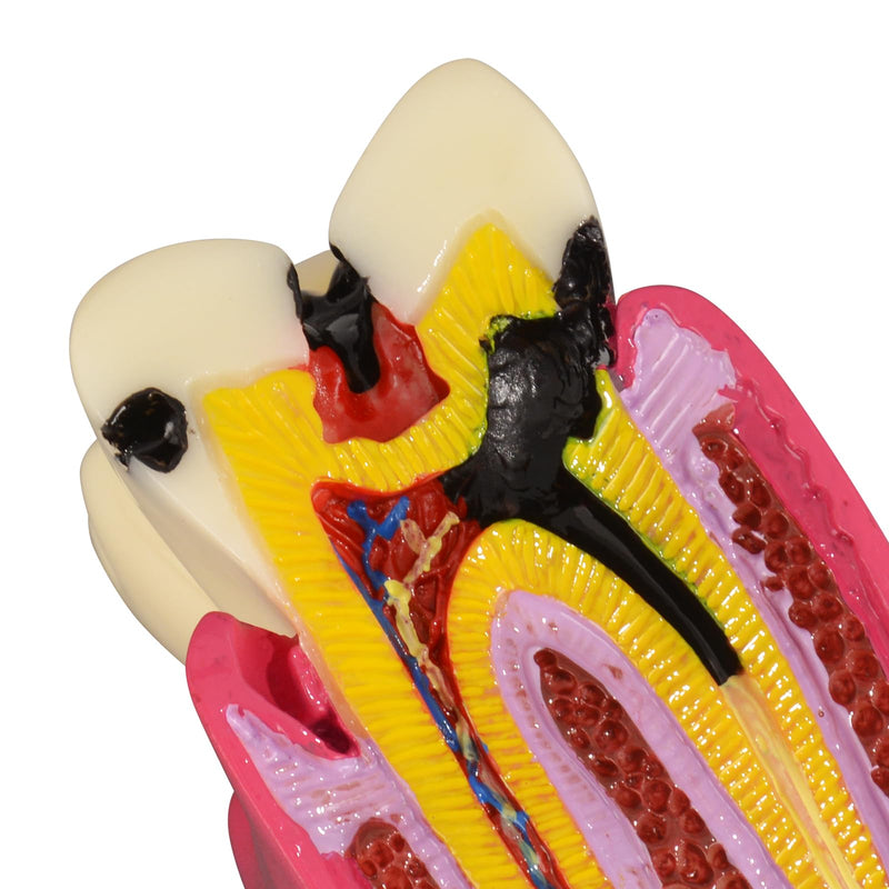 [Australia - AusPower] - Dental Tooth Decay Model 6 Times Dental Caries Teeth Model Caries Bilateral Comparison Pathology Model Teeth for Dental Education Supplies, Tooth Pathology Display 
