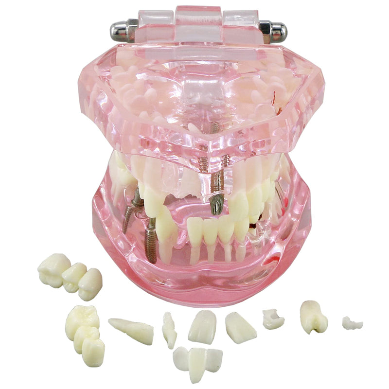 [Australia - AusPower] - Teeth Model Teeth Typodonts Dental Implant Study Analysis Demonstration Teeth Model #2001 with Restoration Pink 