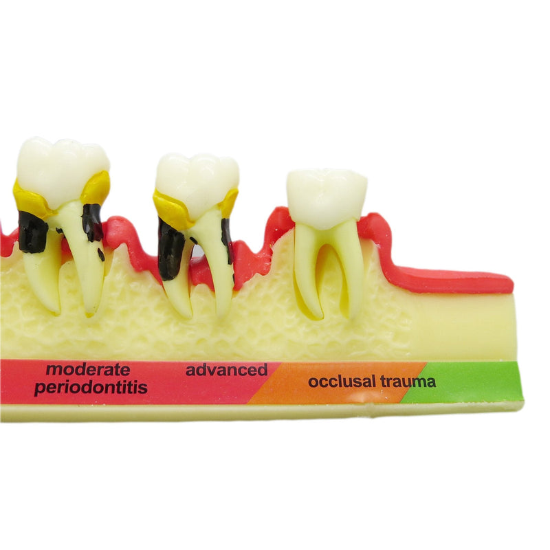 [Australia - AusPower] - Teeth Periodontal Disease Model Dental Caries Breakdown Display Periodontitis Show Teaching Tooth Model Dentist Odontologia Communication 