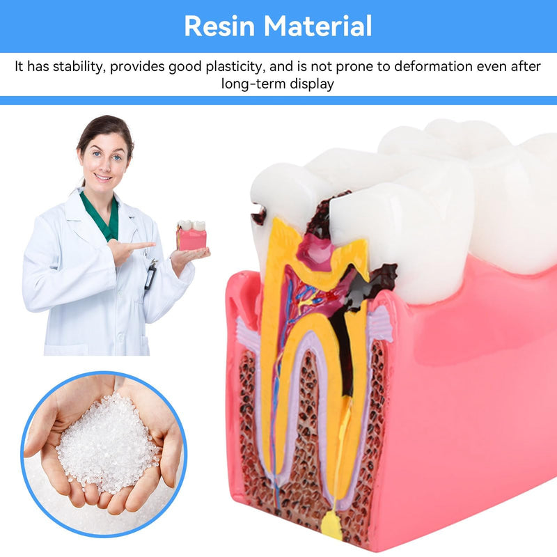 Dental Anatomy Model, Caries Comparison Study Models Dentist Dental Anatomy Training Dental Caries Development Model