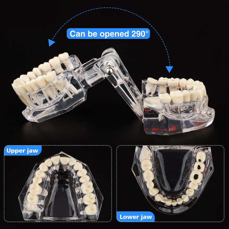 [Australia - AusPower] - Transparent Disease Teeth Model with Dental Implant Bridge, Dental Model for Patient and Dental Student Education 