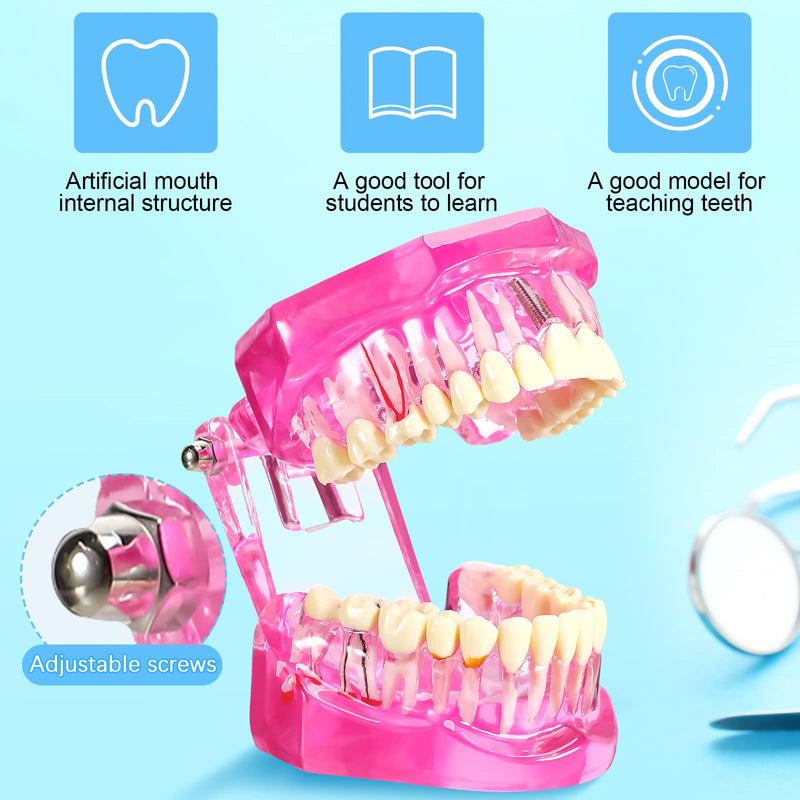 Outus Disease Teeth Model Dental Implant Typodont with Removable Tooth Dentist Standard Tooth Pathological Demonstration for Back to School Education Dental Supplies(Pink,2 Pcs) 2 Pink