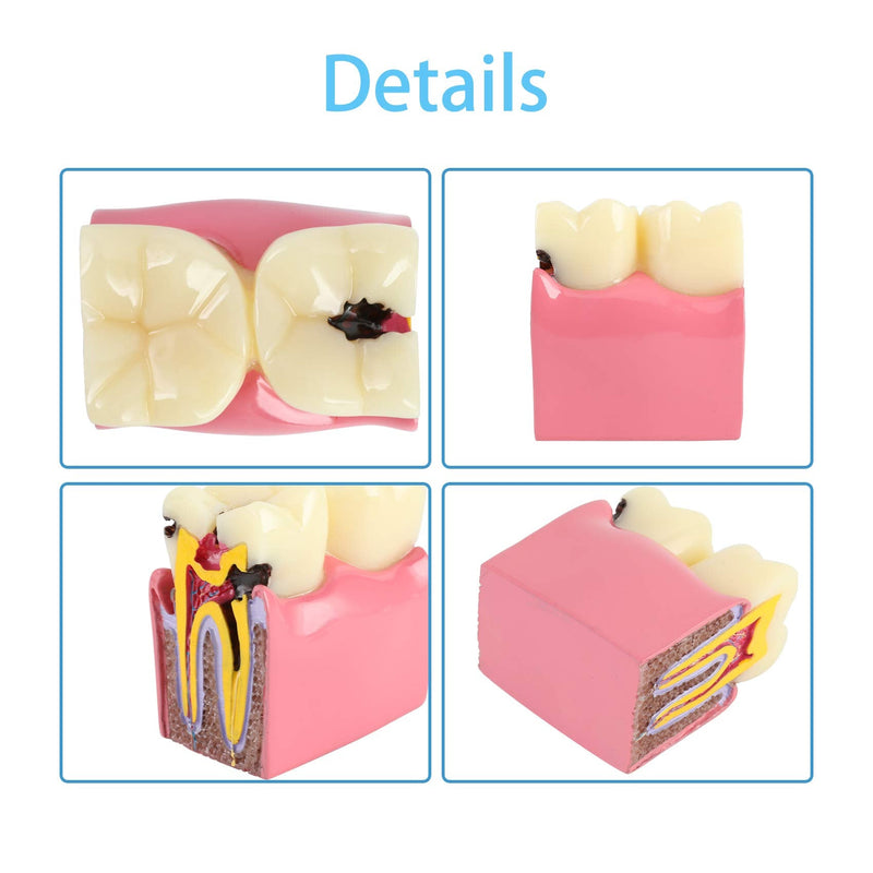 Dental Caries Tooth Model 6 Times Decay Teeth Comparative Study Model, Caries Bilateral Comparison Pathology Teeth Model Teaching Learning Tools for Dentist, Patient Education and Explanation