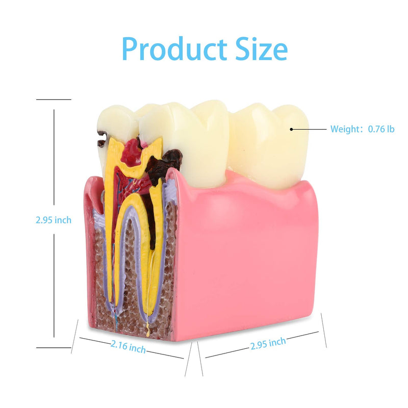 Dental Caries Tooth Model 6 Times Decay Teeth Comparative Study Model, Caries Bilateral Comparison Pathology Teeth Model Teaching Learning Tools for Dentist, Patient Education and Explanation