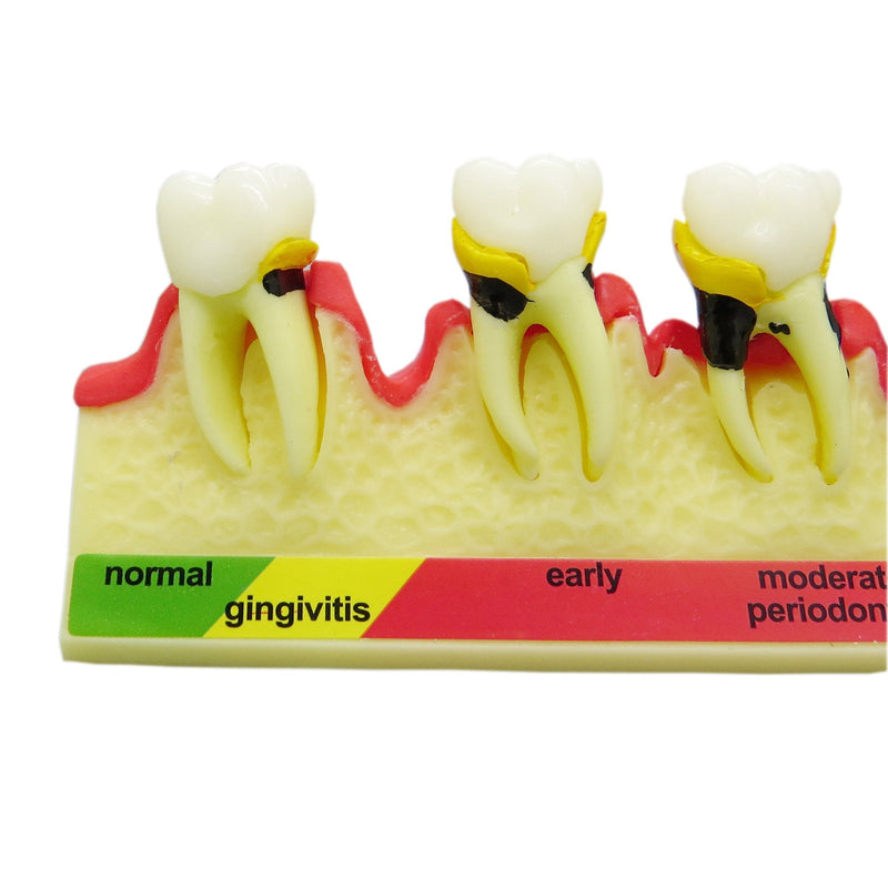 [Australia - AusPower] - Teeth Periodontal Disease Model Dental Caries Breakdown Display Periodontitis Show Teaching Tooth Model Dentist Odontologia Communication 