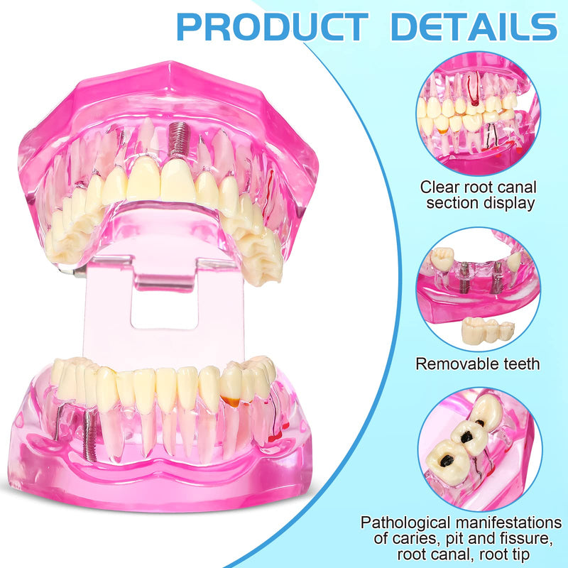Outus Disease Teeth Model Dental Implant Typodont with Removable Tooth Dentist Standard Tooth Pathological Demonstration for Back to School Education Dental Supplies(Pink,2 Pcs) 2 Pink
