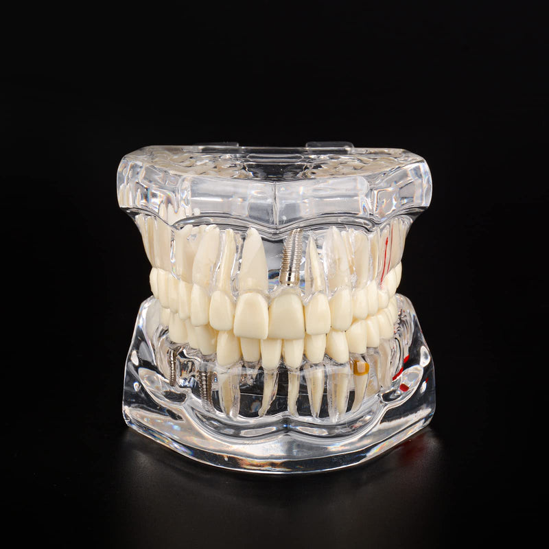 [Australia - AusPower] - Transparent Disease Teeth Model with Dental Implant Bridge, Dental Model for Patient and Dental Student Education 