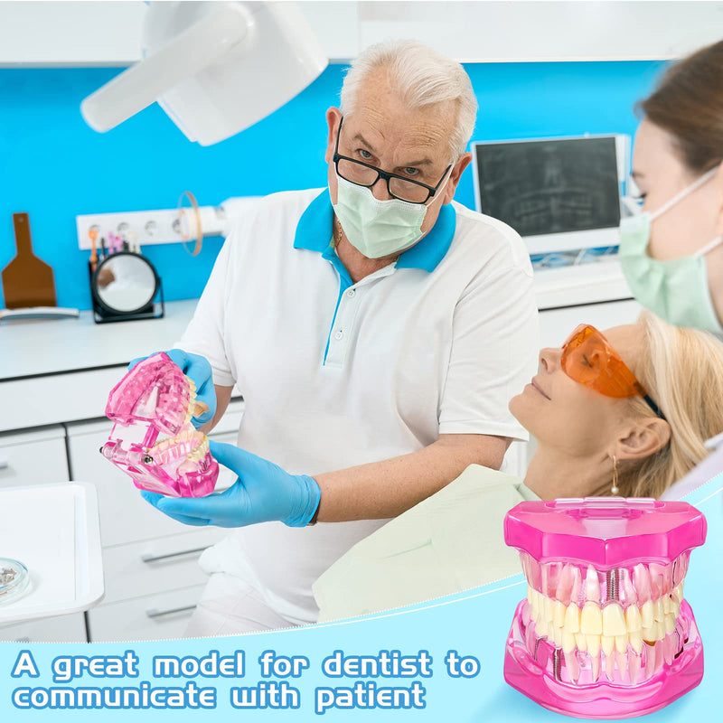 Outus Disease Teeth Model Dental Implant Typodont with Removable Tooth Dentist Standard Tooth Pathological Demonstration for Back to School Education Dental Supplies(Pink,2 Pcs) 2 Pink