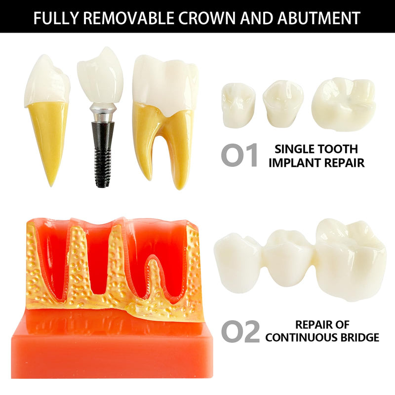 [Australia - AusPower] - Dental Implant Model with Removable Crown Bridge - 4 Times Enlarged Demonstrative Teeth Model for Education and Study - Ideal for Class Demonstrations and Dental Student Training 