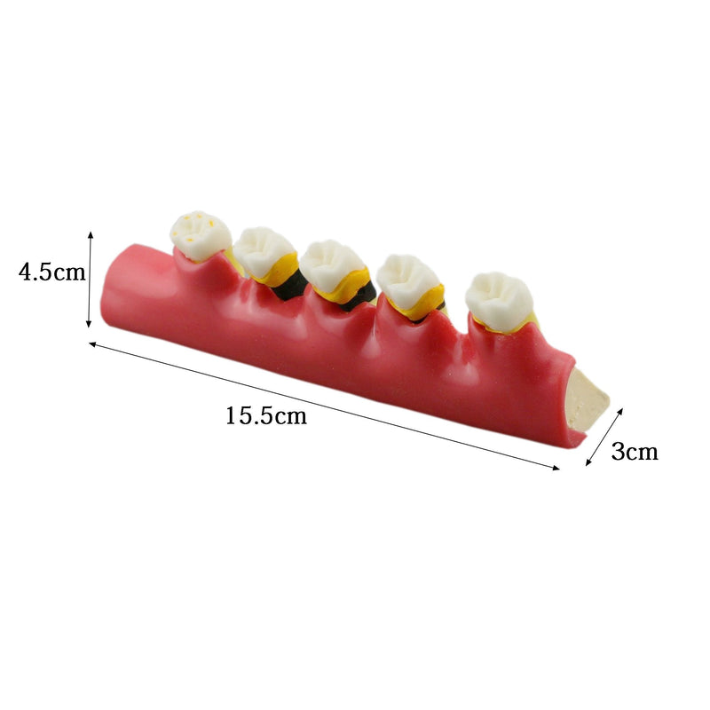 [Australia - AusPower] - Teeth Periodontal Disease Model Dental Caries Breakdown Display Periodontitis Show Teaching Tooth Model Dentist Odontologia Communication 