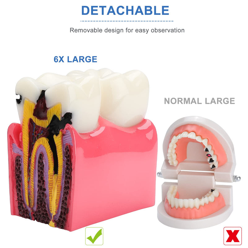 [Australia - AusPower] - Dental Caries Tooth Model - 6 Times Tooth Decay Model Dental Models for Patient Education Root Canal Model Tooth Model for Teaching Kids 