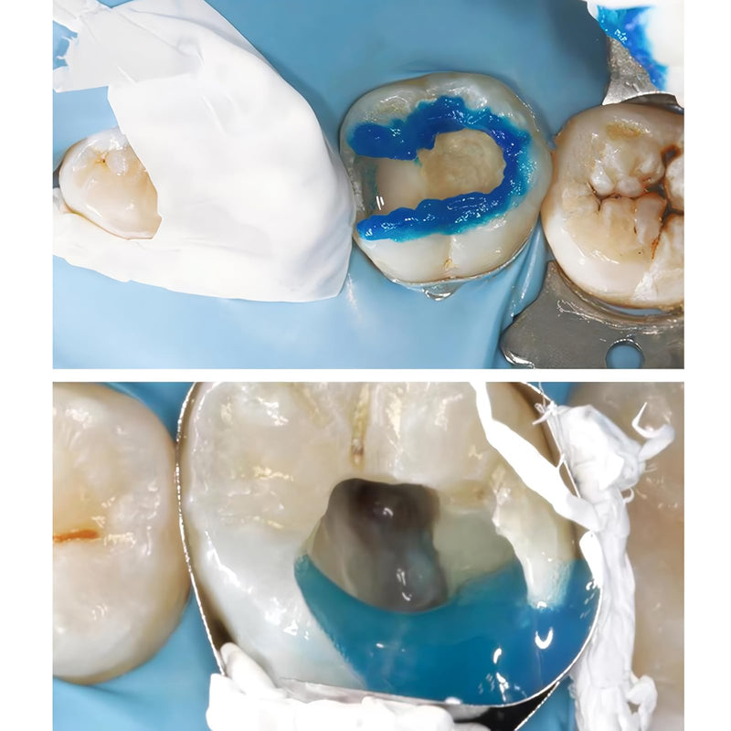 [Australia - AusPower] - Dental Teflon Matrix Bands White Roll Type Sectional Contoured Matrix Band for Plug Matrices Dentistry Oral Material 