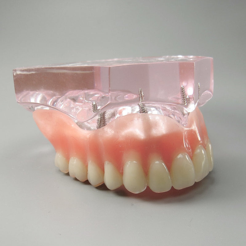 Dental Model Overdenture Upper Teeth 4 Implants Demo for Teaching and Studying
