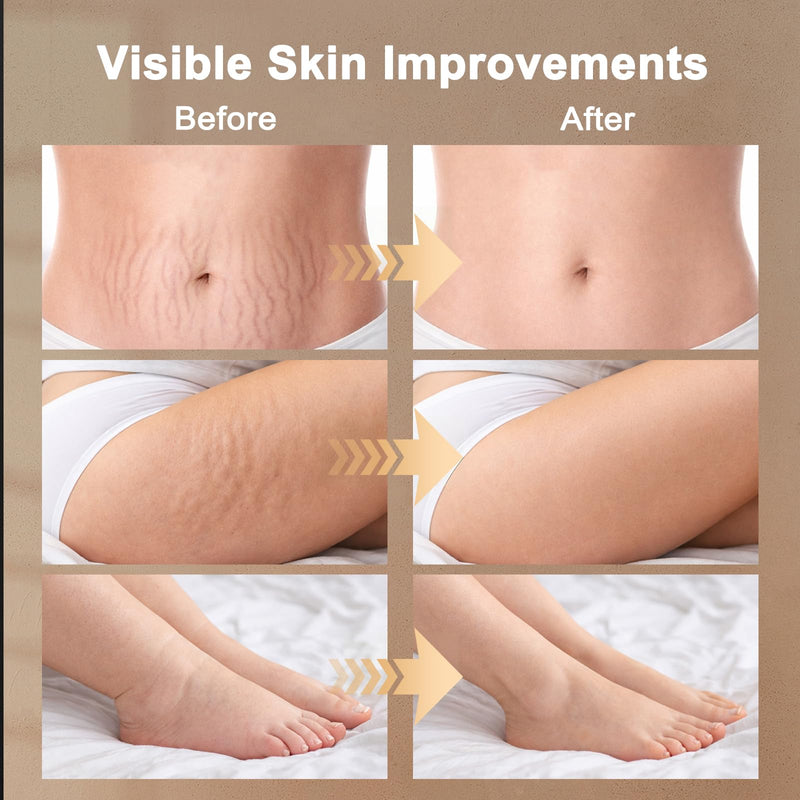[Australia - AusPower] - Lymphatic Drainage Massager, Lymphatic Massager, Helps Reduce Stretch Marks & Cellulite, for Legs, Arms & Belly, Body Sculpting Machine with Microcurrent, Light, Heat & Vibration, White 