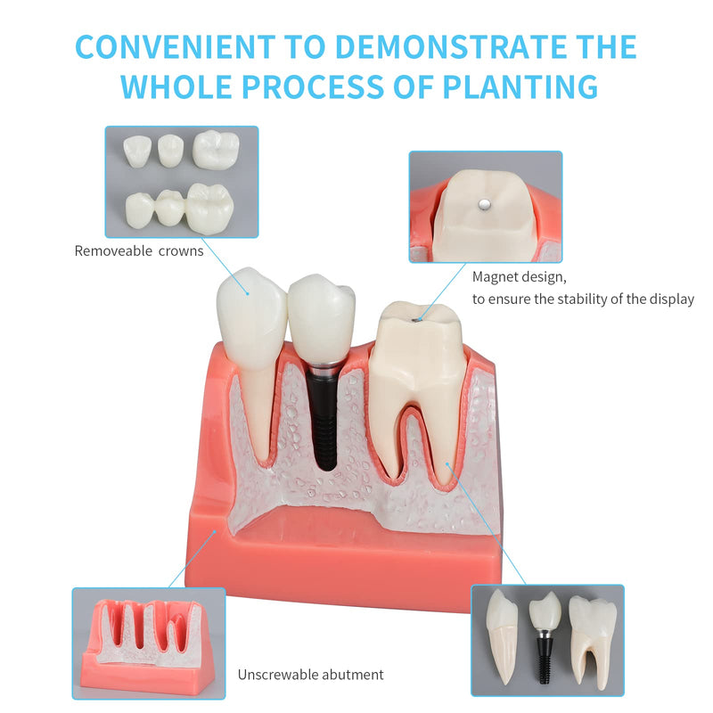 [Australia - AusPower] - ANNWAN Dental Implant Model 4 Times Removable Analysis Crown Bridge Demonstration Teeth Model for Class Education and Studying Teeth Model 