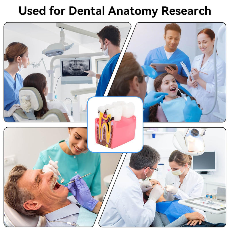 Dental Anatomy Model, Caries Comparison Study Models Dentist Dental Anatomy Training Dental Caries Development Model