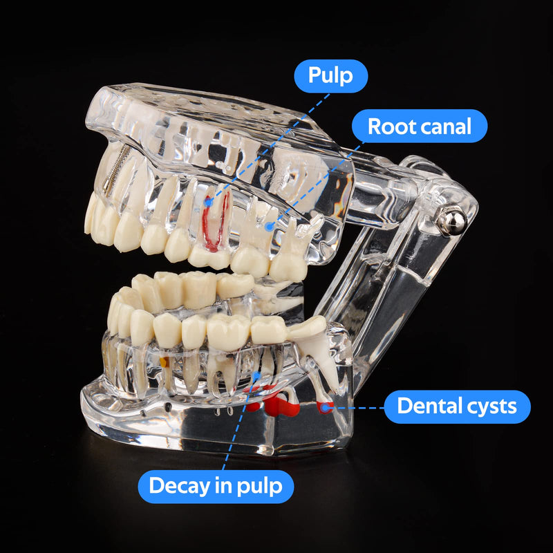 [Australia - AusPower] - Transparent Disease Teeth Model with Dental Implant Bridge, Dental Model for Patient and Dental Student Education 
