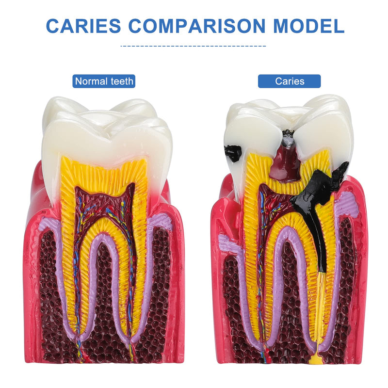 [Australia - AusPower] - Dental Caries Tooth Model - 6 Times Tooth Decay Model Dental Models for Patient Education Root Canal Model Tooth Model for Teaching Kids 