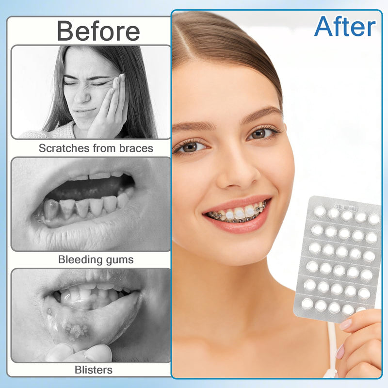 Pack of 180 Orthodontic Wax, Individually Packed, Relieves Irritation and Pain Caused by Friction of Braces, Suitable for Braces (Mint, Strawberry, Original)