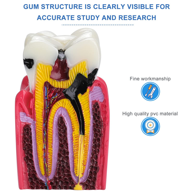[Australia - AusPower] - Dental Caries Tooth Model - 6 Times Tooth Decay Model Dental Models for Patient Education Root Canal Model Tooth Model for Teaching Kids 