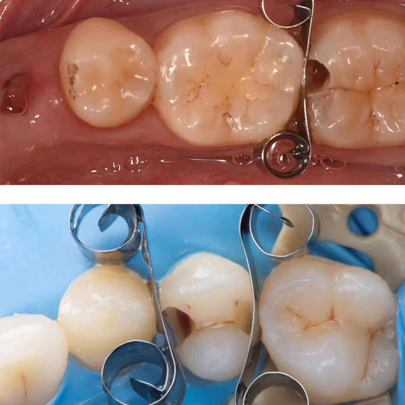 [Australia - AusPower] - Dental Adjacent Tooth Protection Matrix, Autoclavable Sectional Contoured Matrices Baffle Type Matrix Dentistry Tools Materials.-L Large 