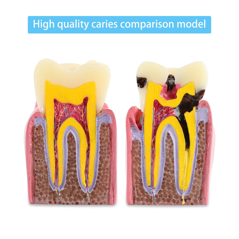 Dental Caries Tooth Model 6 Times Decay Teeth Comparative Study Model, Caries Bilateral Comparison Pathology Teeth Model Teaching Learning Tools for Dentist, Patient Education and Explanation