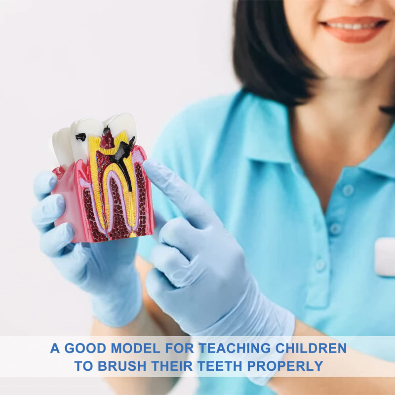 [Australia - AusPower] - Dental Caries Tooth Model - 6 Times Tooth Decay Model Dental Models for Patient Education Root Canal Model Tooth Model for Teaching Kids 