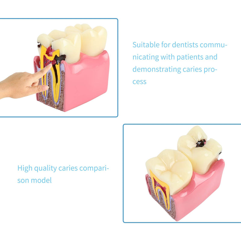 Dental Caries Tooth Model 6 Times Decay Teeth Comparative Study Model, Caries Bilateral Comparison Pathology Teeth Model Teaching Learning Tools for Dentist, Patient Education and Explanation